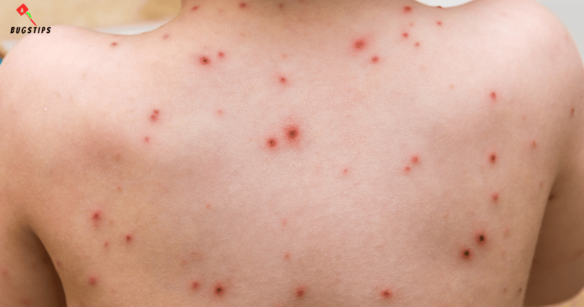 Bed Bugs or Chicken Pox: Understanding the Difference and How to Deal ...