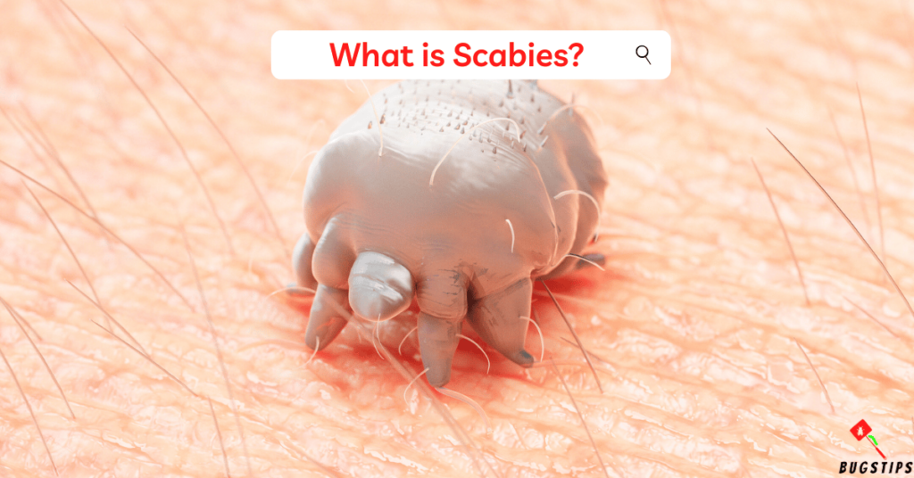 Bed Bugs vs Scabies (scabies)